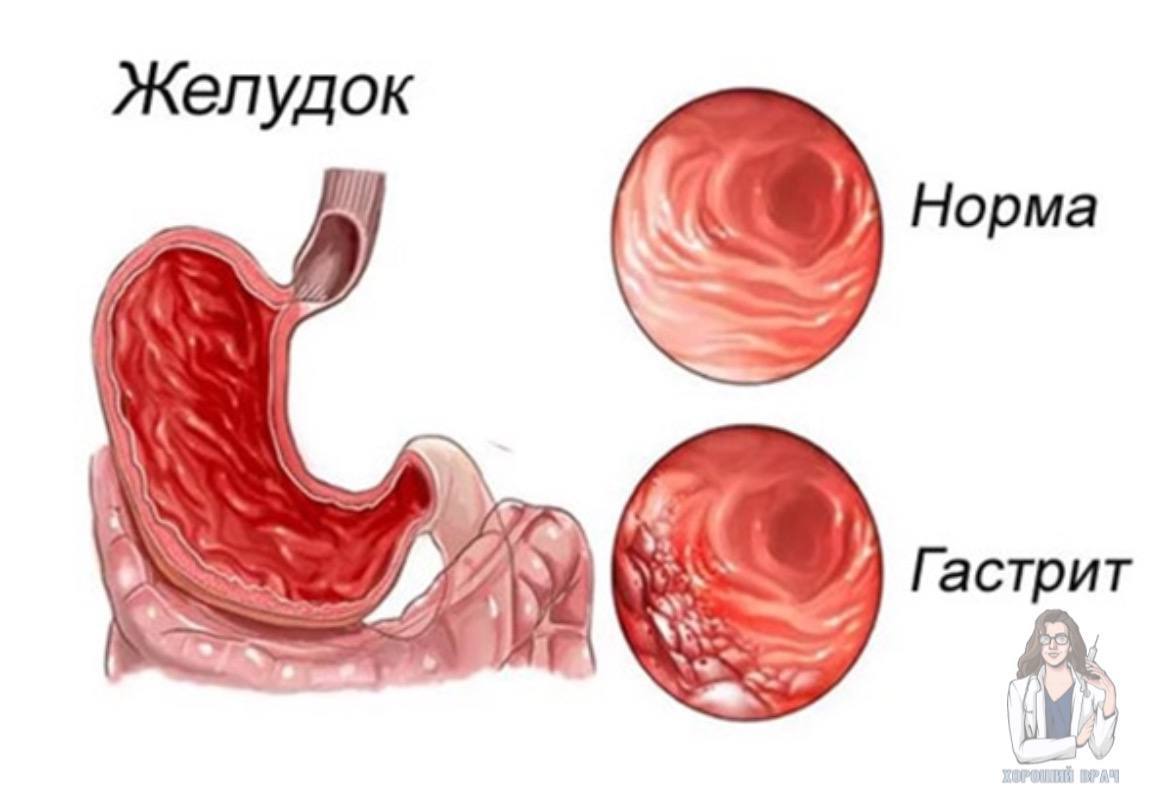 Острый гастрит что это. Острый гастрит желудка. Формы острого гастрита коррозивный. Задача по острому гастриту. Рекомендации при хроническом гастродуодените у детей.