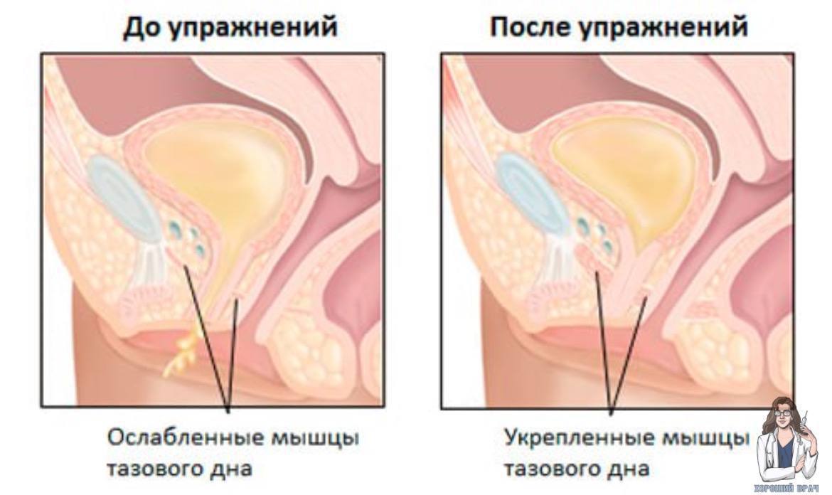 Опущение Влагалища Фото